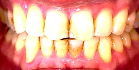 What is Gingivitis? Know the Signs, Causes, and How to Prevent It